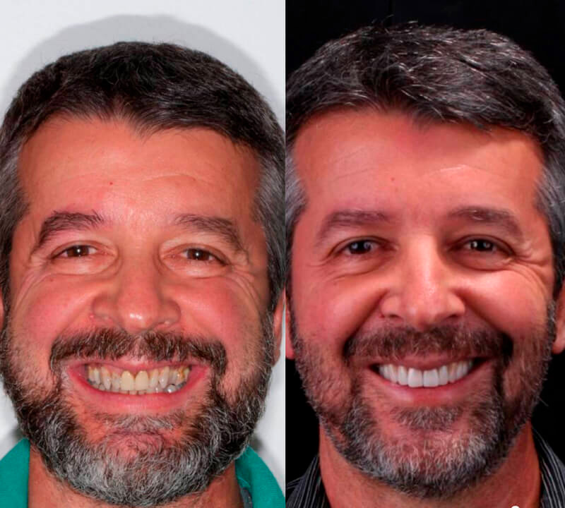 Facetas e lentes de contato dental - Castelo - BH